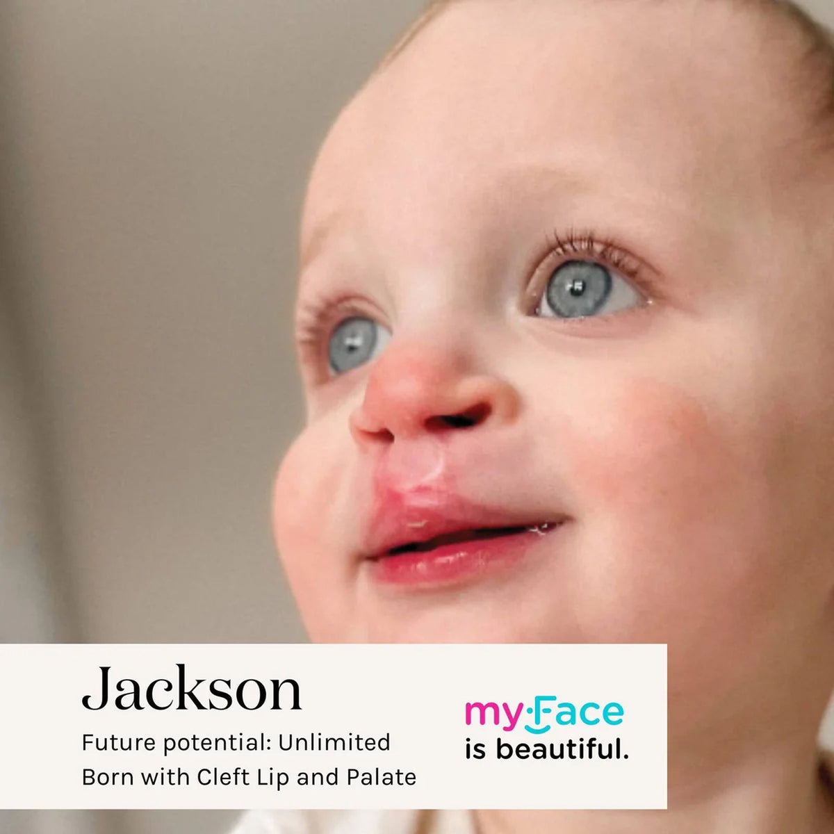 myFace personal story