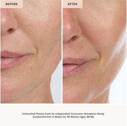 Before and after comparison of a woman's face showing skin improvement.